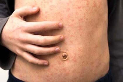 Measles Horror Unfolds: Two Kids Lost, 17 More Infected