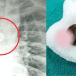 A 32-year-old man slept with a 25-paise coin in his mouth, the coin remained stuck in his windpipe for 8 years
