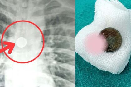 A 32-year-old man slept with a 25-paise coin in his mouth, the coin remained stuck in his windpipe for 8 years