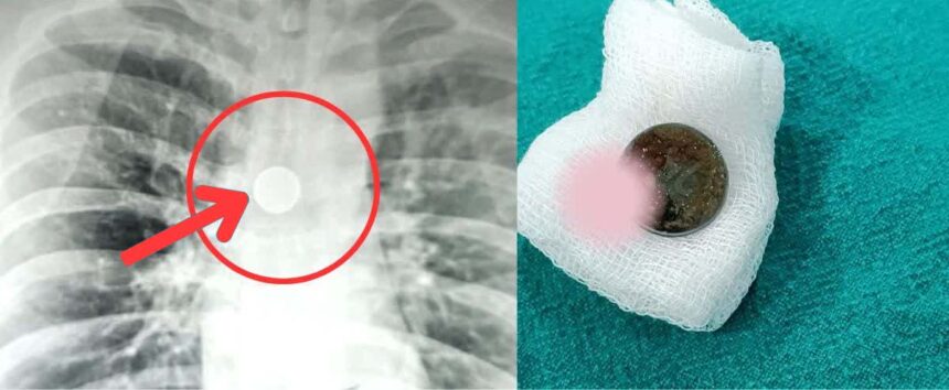 A 32-year-old man slept with a 25-paise coin in his mouth, the coin remained stuck in his windpipe for 8 years