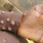 Monkeypox alert after Covid! WHO declares health emergency