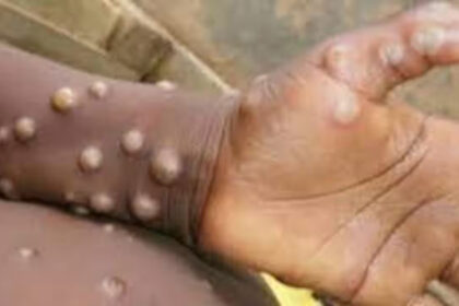 Monkeypox alert after Covid! WHO declares health emergency