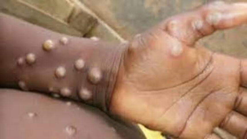 Monkeypox alert after Covid! WHO declares health emergency